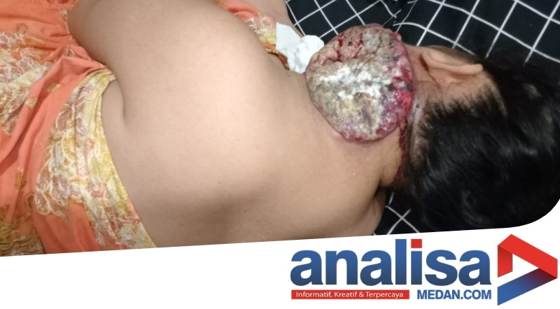 Waduh! Meski Kanker Sudah Berulat, Warga Sidimpuan "Dipulangkan" RS Adam Malik Hanya Berobat Jalan